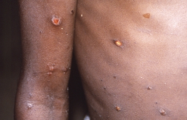 200명 넘게 사망한 무서운 그 바이러스 또···아시아서 '새 변이' 발견됐다