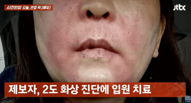 마트 직원 설명 따라 했는데 ‘펑’...‘곱창 폭발’에 2도 화상, 누구 책임?