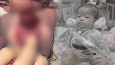 심장 몸밖에 나온채 태어난 신생아 생존기 화제