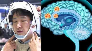 "초음파로 뇌 청소"...치매 치료기기 나온다