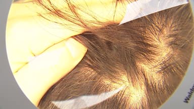 "탈모는 생존 문제"라지만...재정 부담·우선 순위 '난관'