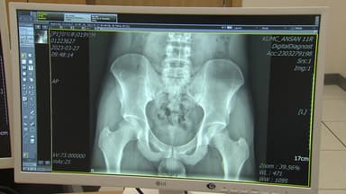 뻣뻣한 허리 방치하면 척추 위험...강직성 척추염 주의