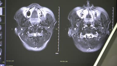 "혈액 한 방울로 치매 예측"...13년 연구로 치매 예보 완성