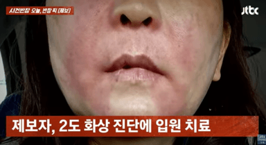 마트 직원 설명 따라 했는데 ‘펑’...‘곱창 폭발’에 2도 화상, 누구 책임?